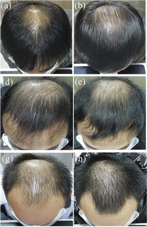 finasteride results 6 months